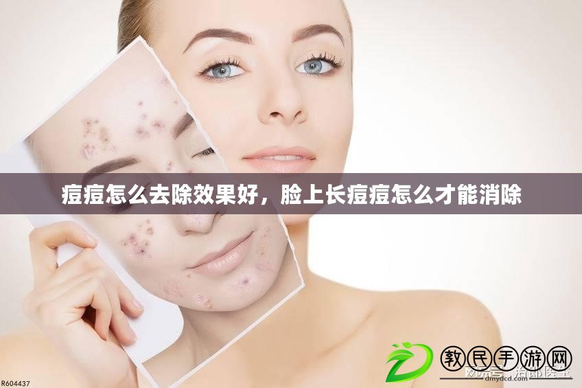 痘痘怎么去除效果好，臉上長痘痘怎么才能消除